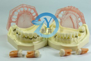 牙周病模型