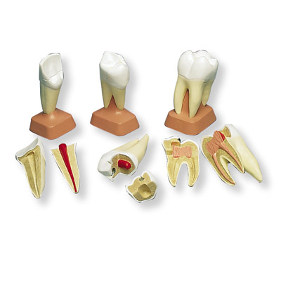 进口上颌三根龋臼齿模型(2部分-德国3b-ve298
