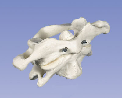 进口环椎和枢椎组合-无基架-德国3B-A71